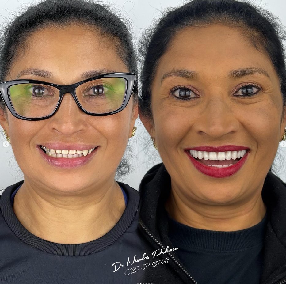 Antes e Depois 2